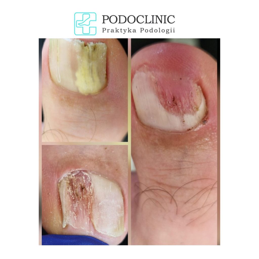 Grzybica paznokcia Podoclinic