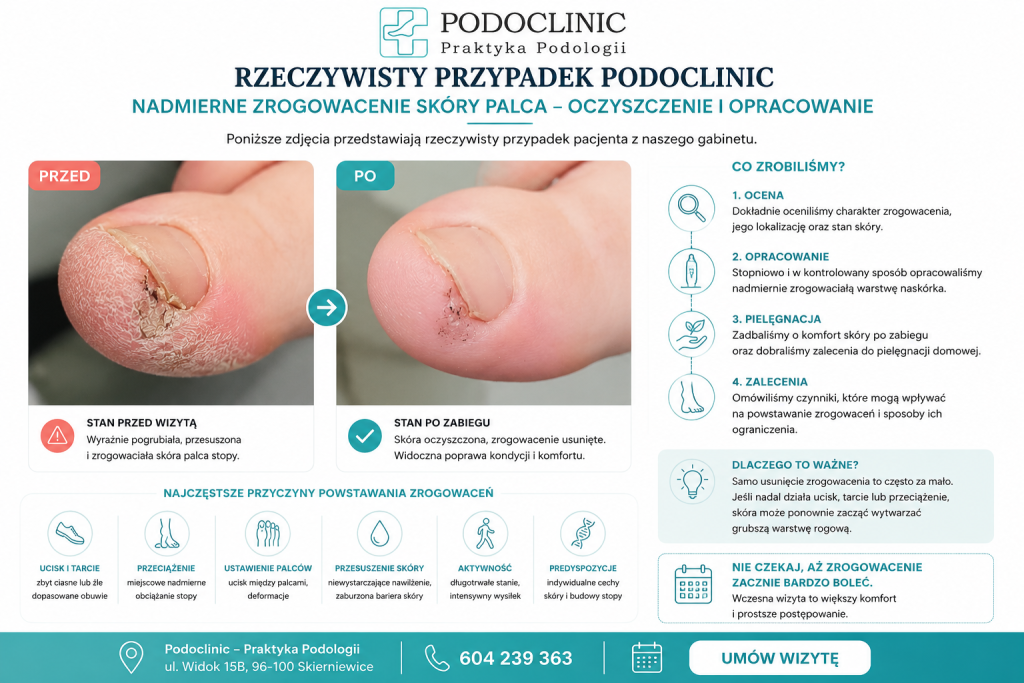 Nadmierne rogowacenie skóry stóp