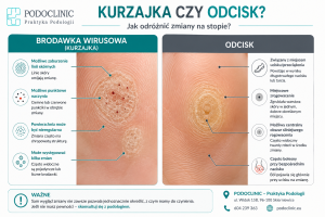 Kurzajka czy odcisk Jak rozpoznać zmianę na stopieskierniewice
